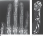 31 Osteopenic Diseases in the Hands