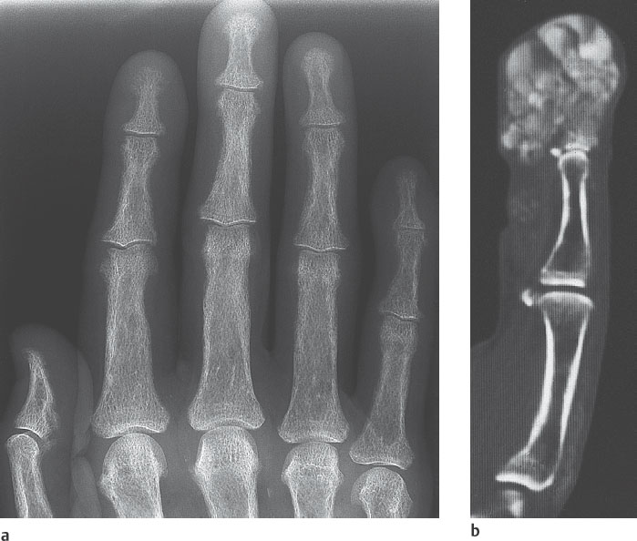 31 Osteopenic Diseases in the Hands | Radiology Key