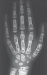 34 Crystal-induced Osteoarthropathies and Related Diseases