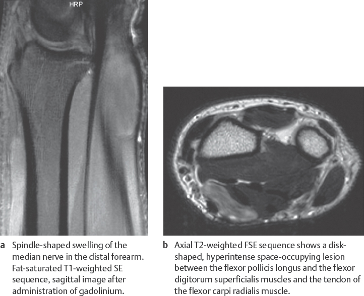 45 Soft Tissue Tumors Radiology Key