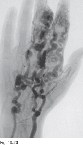 48 Vascular Diseases of the Hand and Fingers | Radiology Key