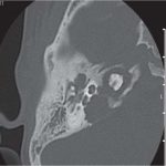 The Temporal Bone: Syndromes Associated With Ear Anomalies