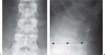 The Pediatric Vertebral Column: Anomalies of the Spinal Canal and Neural Arches