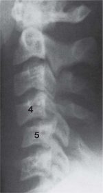 The Pediatric Vertebral Column: Anomalies of the Intervertebral Foramina