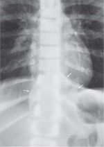 The Pediatric Vertebral Column: The Spinal Canal and Its Contents
