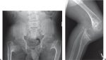 Pelvis: Ischium and Pubic Bones