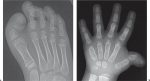 Hands and Feet: Brachydactyly