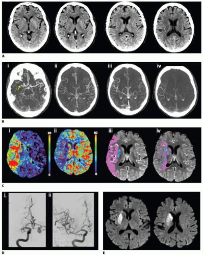 Brain Ct Perfusion Imaging Cerebral Ischemia Radiology Key 0243