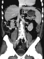 Vascular Anatomy of the Abdominal Aorta and the Inferior Vena Cava