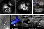 Innovations in Vascular Ultrasound