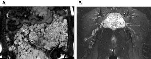 Pdf Understanding Vascular Malformation Healthclips Online