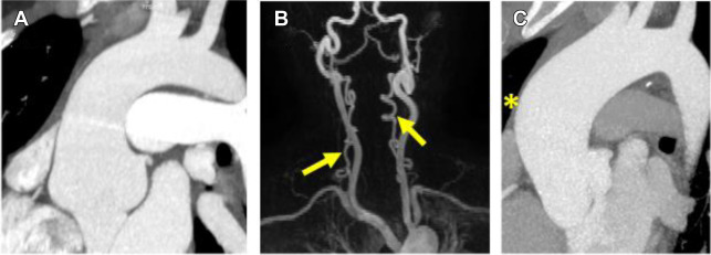 Imaging Thoracic Aortic Aneurysm | Radiology Key