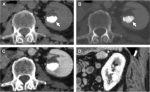 Approach to Renal Cystic Masses and the Role of Radiology