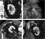 Percutaneous Thermal Ablation for Treatment of T1a Renal Cell Carcinomas