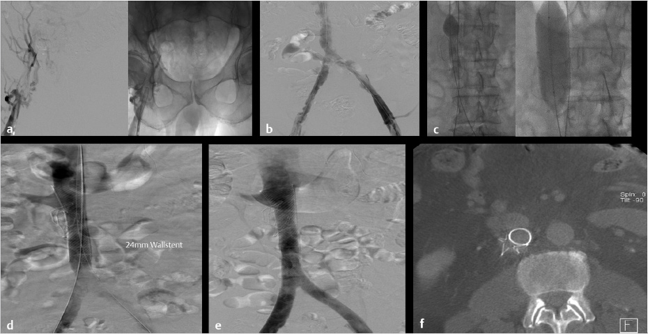 venogram venous occlusive disease