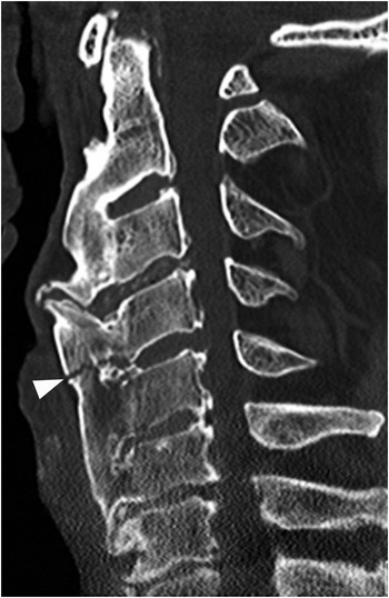 Section 6 – Trauma to Compromised Spine | Radiology Key