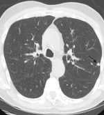 Pulmonary CT: The Scanner, the Protocol, and the Dose
