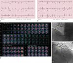 Problem-Oriented Radionuclide Myocardial Perfusion Imaging