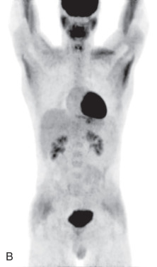 Thoracic Nuclear Imaging | Radiology Key