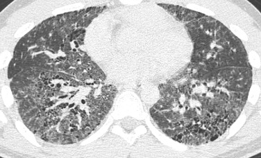 Interstitial Lung Disease | Radiology Key