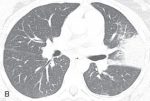 Eosinophilic Lung Disease