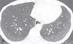 Cystic Lung Disease