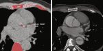 Cardiac CT for the Evaluation of Acute Coronary Syndrome in the Emergency Department