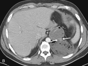 Imaging of Thoracic Trauma | Radiology Key