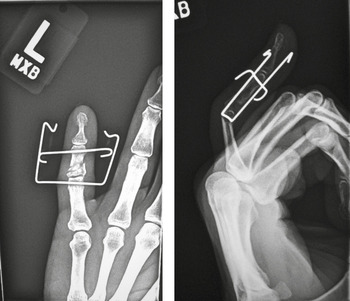 3 – Fracture Fixation | Radiology Key