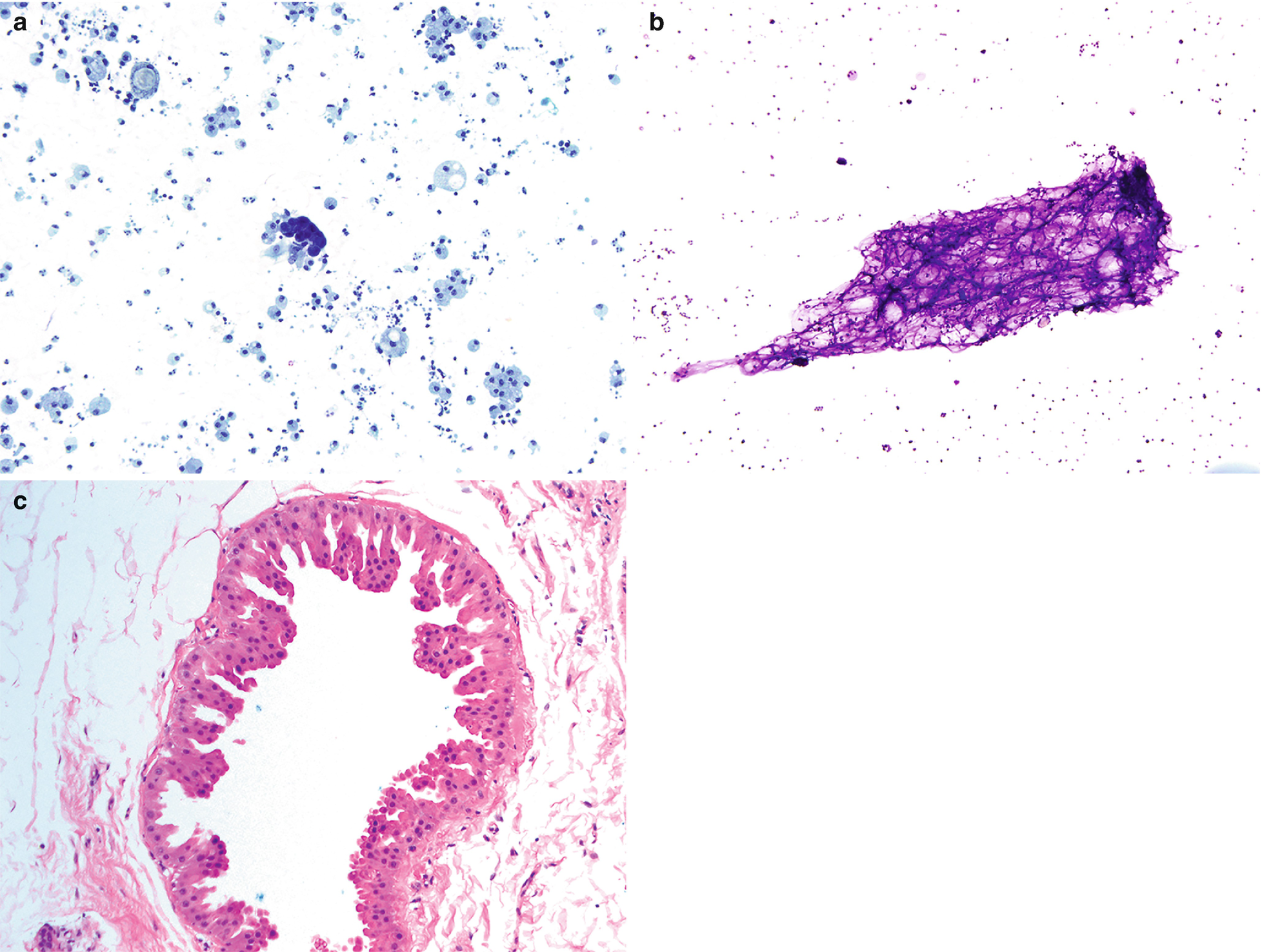 Fine Needle Aspiration (FNA) of the Breast