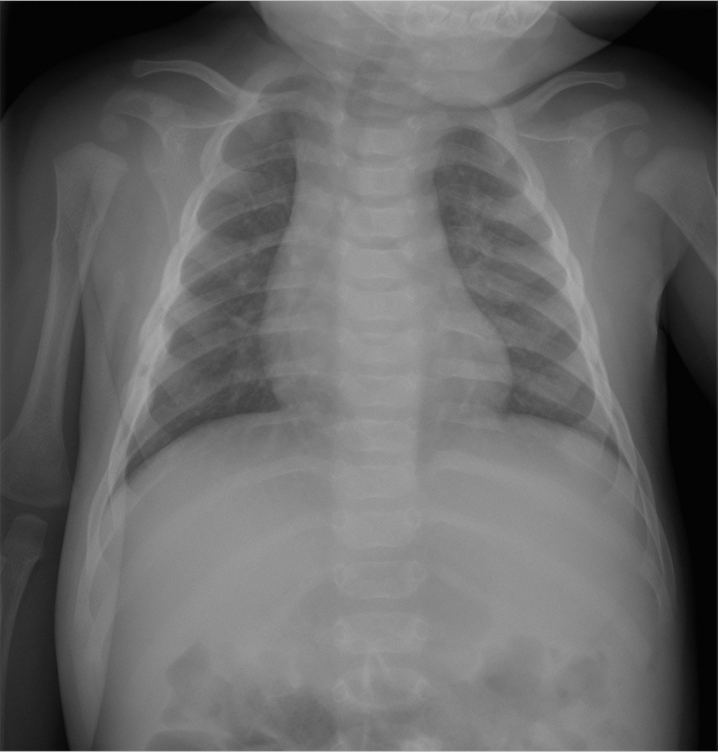 Metaphysis, Radiology Reference Article