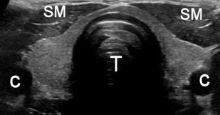Normal Thyroid Ultrasound