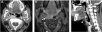 Computed Tomography and MR Imaging of Thyroid Disease