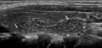 Ultrasound of the Normal Thyroid with Technical Pearls and Pitfalls