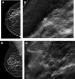Management of High-Risk Breast Lesions