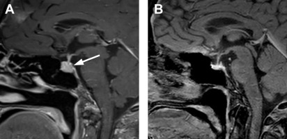 Neuroimaging of the Pituitary Gland | Radiology Key