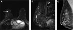 Magnetic Resonance Imaging in Screening of Breast Cancer