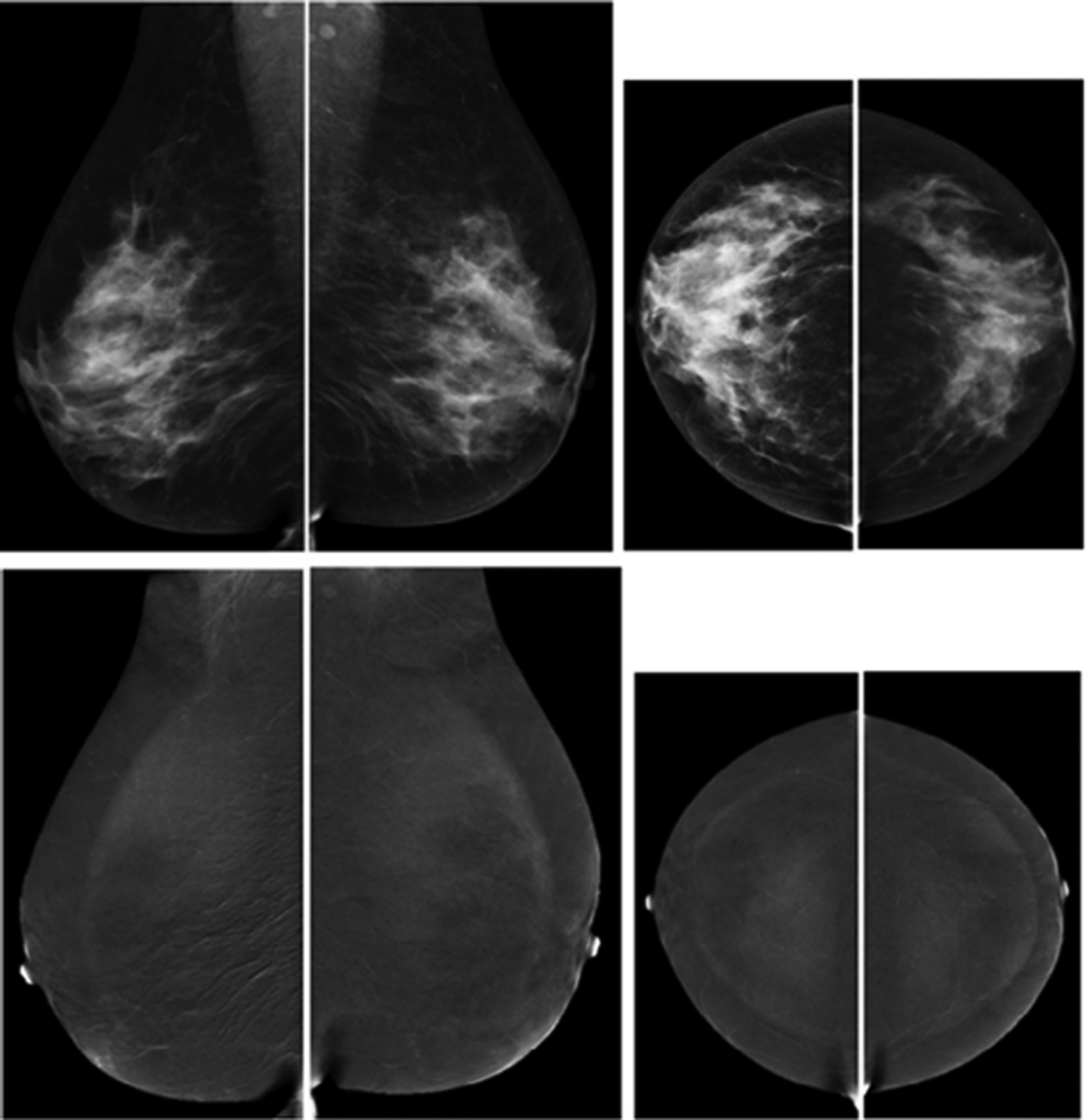 Contrast Enhanced Mammography Implementation Performance And Use For Supplemental Breast