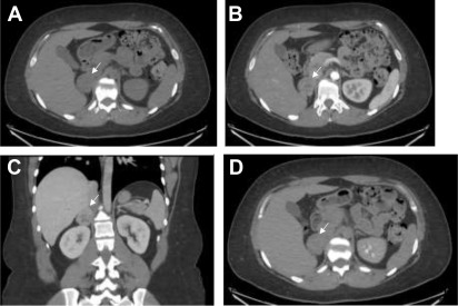 Imaging Of Adrenal-Related Endocrine Disorders | Radiology Key