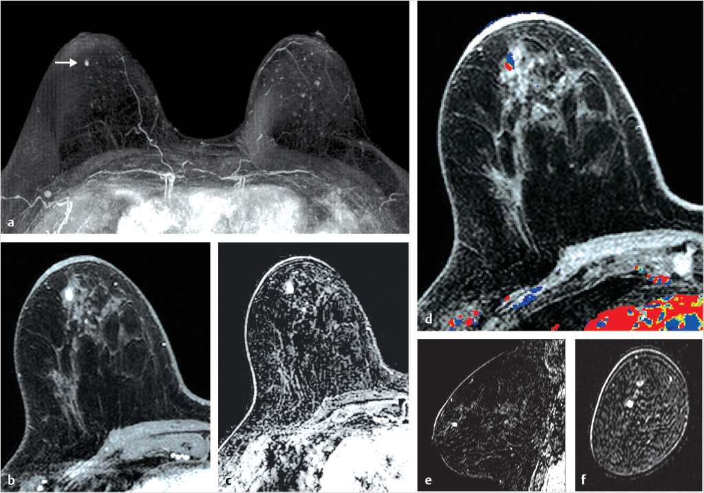 1 Breast Mri Overview Radiology Key 0249