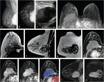 8 Image Interpretation: Invasive Cancer