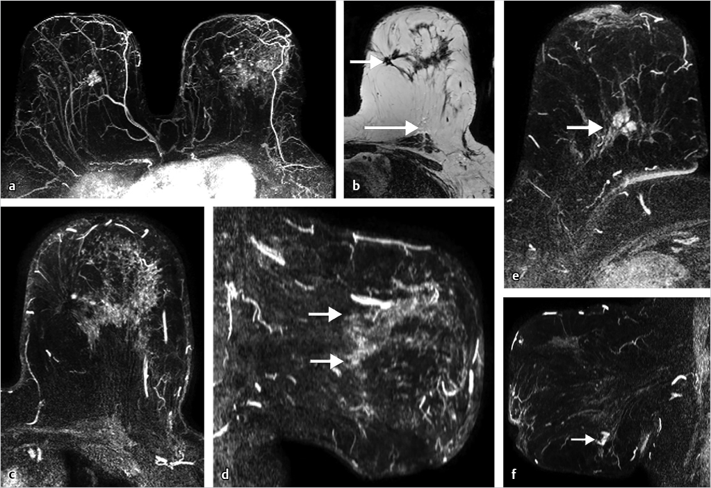 Preoperative tumor size measurement in breast cancer patients