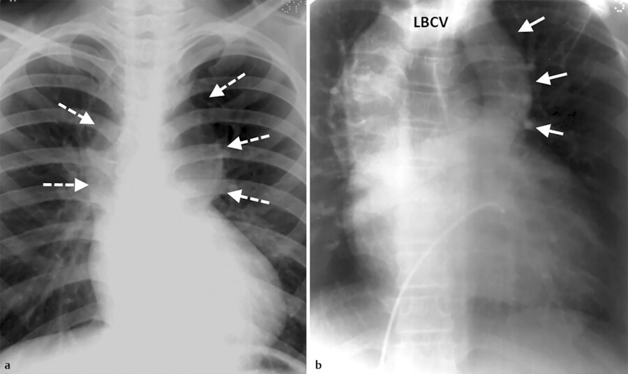 pulmonary-vein-anatomy-function-location-ablation-stenosis-thrombosis