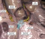 13 Atrioventricular Septal Region