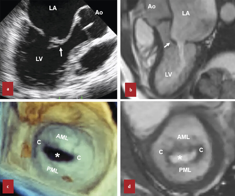 16 The Mitral Valve Radiology Key