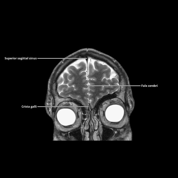 Cranial Meninges Diagram