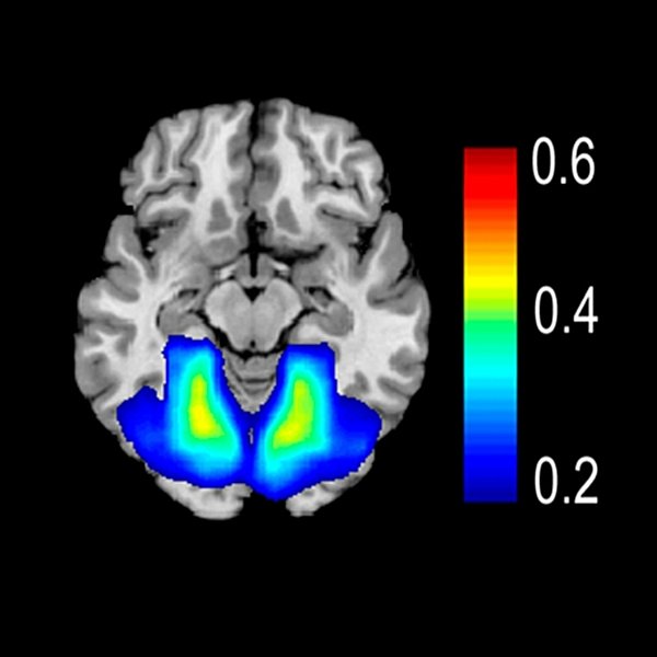 Retrosplenial Cingulate Cortex (Areas 29, 30) | Radiology Key