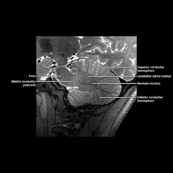 Brainstem and Cerebellum Overview | Radiology Key