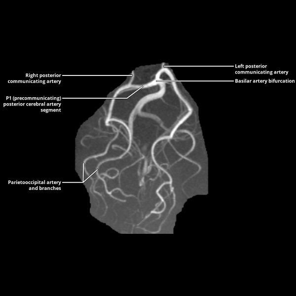 Vertebrobasilar System Radiology Key