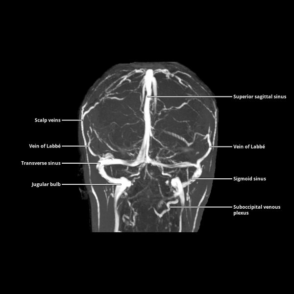 Intracranial Venous System Overview Radiology Key